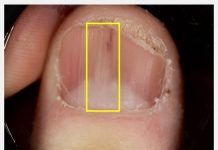 指甲也會長腫瘤? 皮膚科醫師提醒「這些變化」別忽視