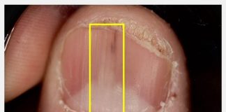 指甲也會長腫瘤? 皮膚科醫師提醒「這些變化」別忽視