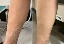 浮腳筋不痛不用管?6旬婦忍30年突腫痛!醫:血栓風險高5.3倍
